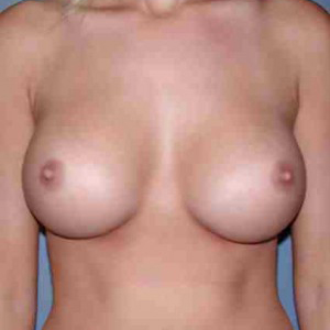 After picture of a female client - Breast Augmentation