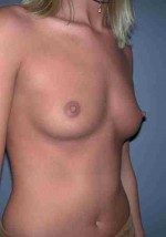 Breast Augmentation with Round Implants