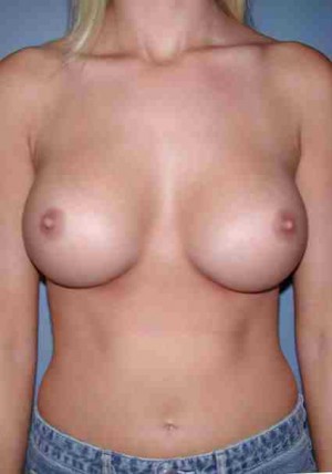 Breast Augmentation with Round Implants