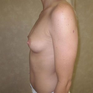 Breast Augmentation with Round Implants