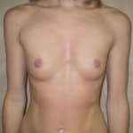 Breast Augmentation with Round Implants