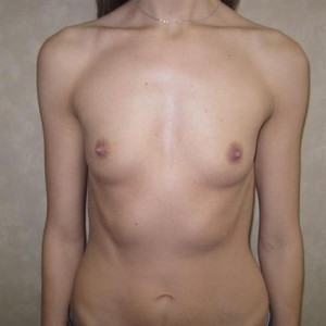 Breast Augmentation with Round Implants