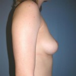 Breast Augmentation with Round Implants