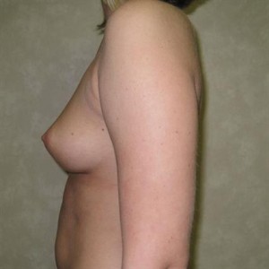 Breast Augmentation with Round Implants