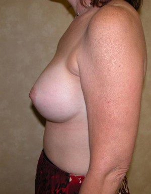 Breast Aug with Shaped Gel 