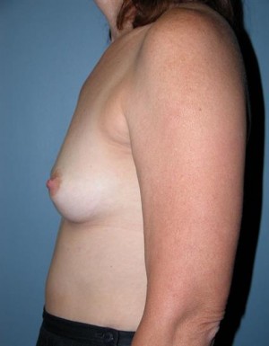 Breast Aug with Shaped Gel 