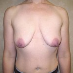 Breast Lift