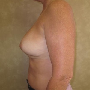 Breast Implant Replacement