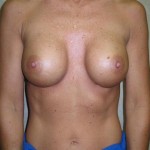 Breast Implant Replacement