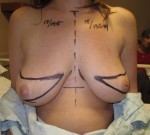 Breast Reconstruction