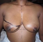 Breast Reconstruction