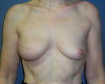 Breast Reconstruction