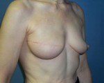 Breast Reconstruction