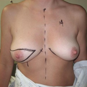 1. Pre Mastectomy Markings