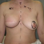 Breast Reconstruction