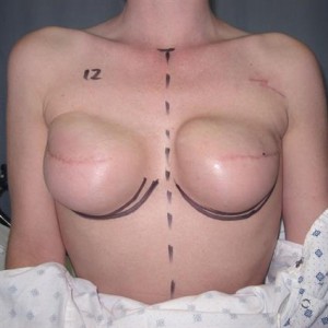 3 POSTOP FRONTAL