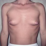 Breast Reconstruction