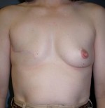 Breast Reconstruction