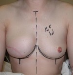 Breast Reconstruction