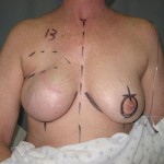 Breast Reconstruction