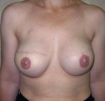 Breast Reconstruction