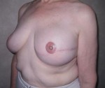 Breast Reconstruction