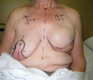 2. Markings For Tissue Expander Removal, Permanent-Implant Placement And Lift Of Right-Side