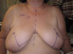 Breast Reconstruction