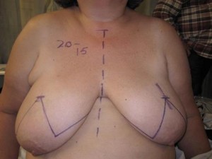 2. Mastectomy Markings