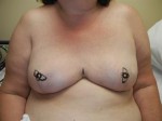 Breast Reconstruction