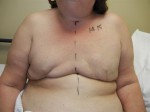 Breast Reconstruction