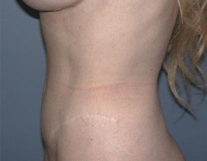 Tummy Tuck