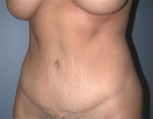 Tummy Tuck