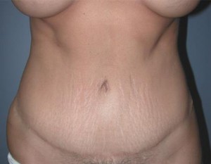 Tummy Tuck