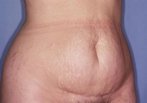 Tummy Tuck