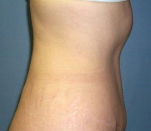 Tummy Tuck