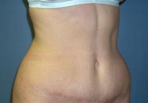 Tummy Tuck