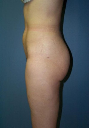 Liposuction