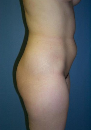 Liposuction