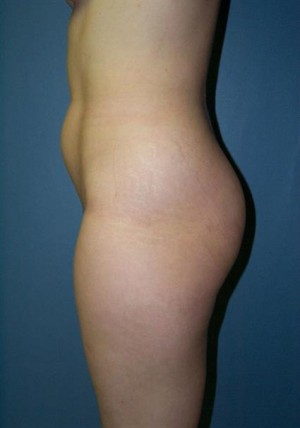 Liposuction