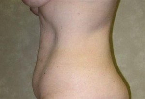 Tummy Tuck