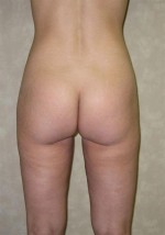 Liposuction