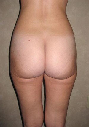 Liposuction