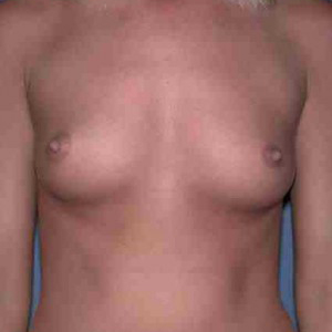 Before picture of a female client - Breast Augmentation