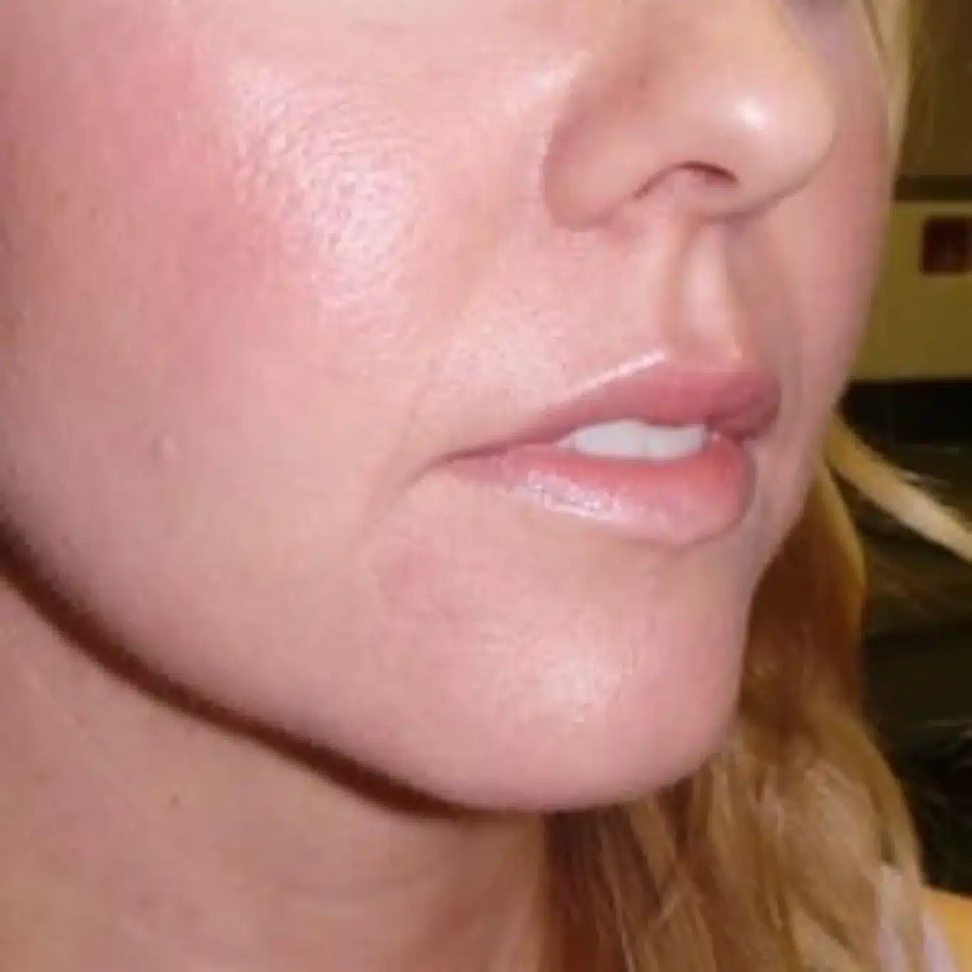 before close-up of mouth area showing thin lips and nasolabial folds prior to juvederm ultra