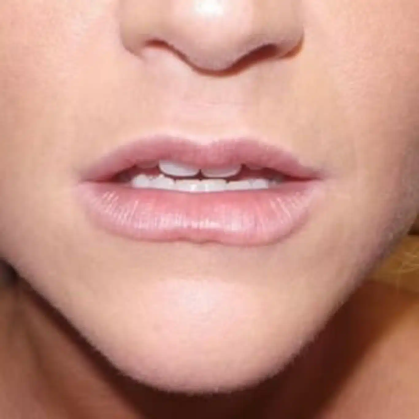 frontal after close-up of plump well-defined lips following Juvederm Ultra
